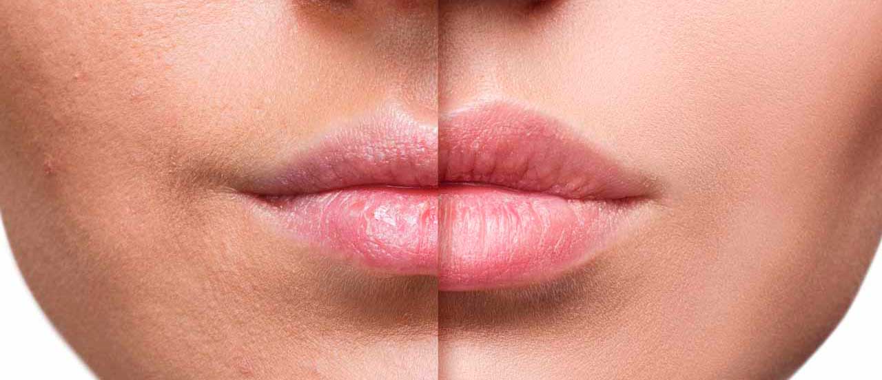 aumento de labios