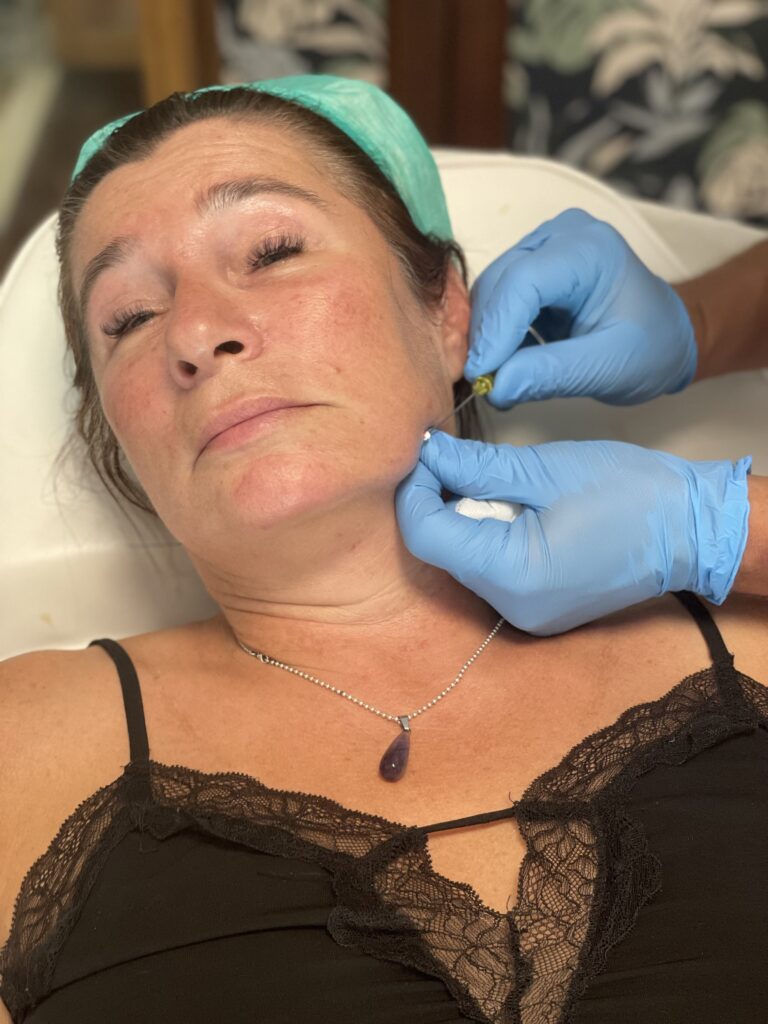 hilos tensores antes y después