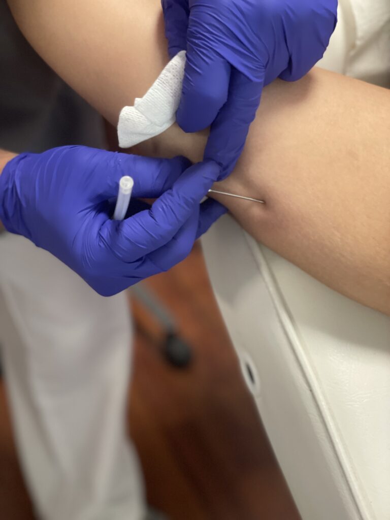 Hilos tensores antes y después brazos