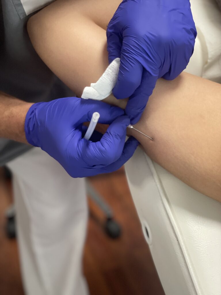 resultados hilos antes y después brazos