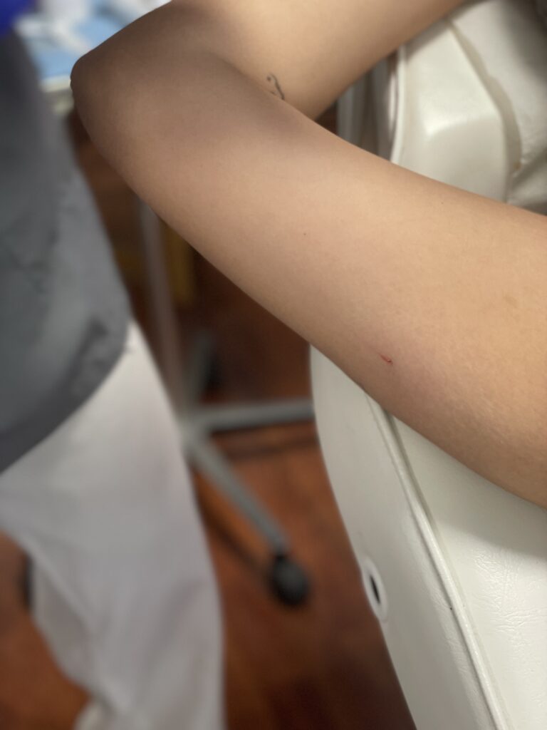 Hilos tensores en brazos