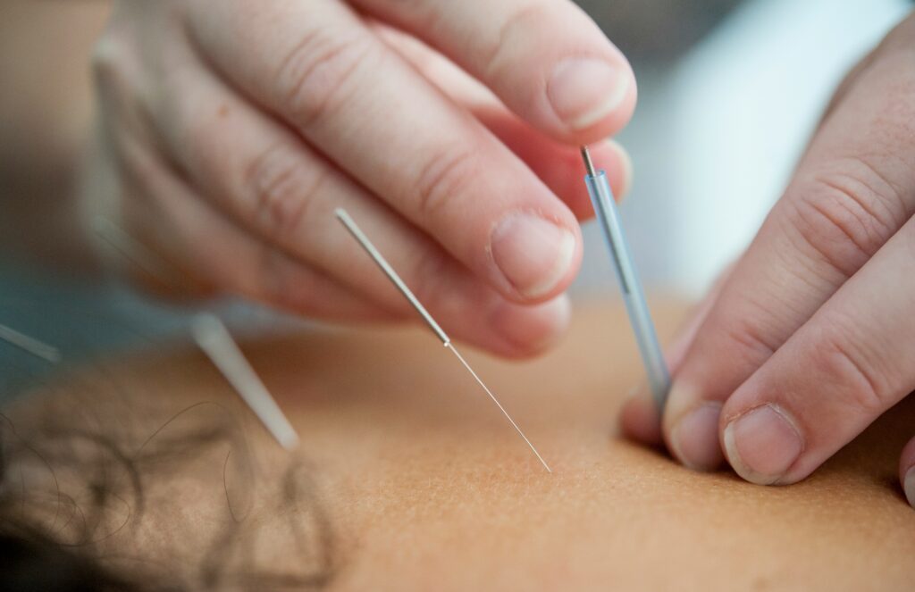 tratamiento de acupuntura